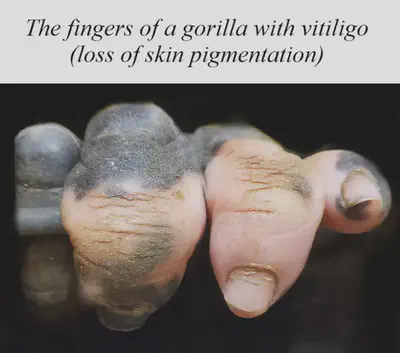 Vitiligo is an autoimmune disease that removes pigmentation from skin. A gorilla's fingers look strikingly similar to a human's when the black pigment is removed.